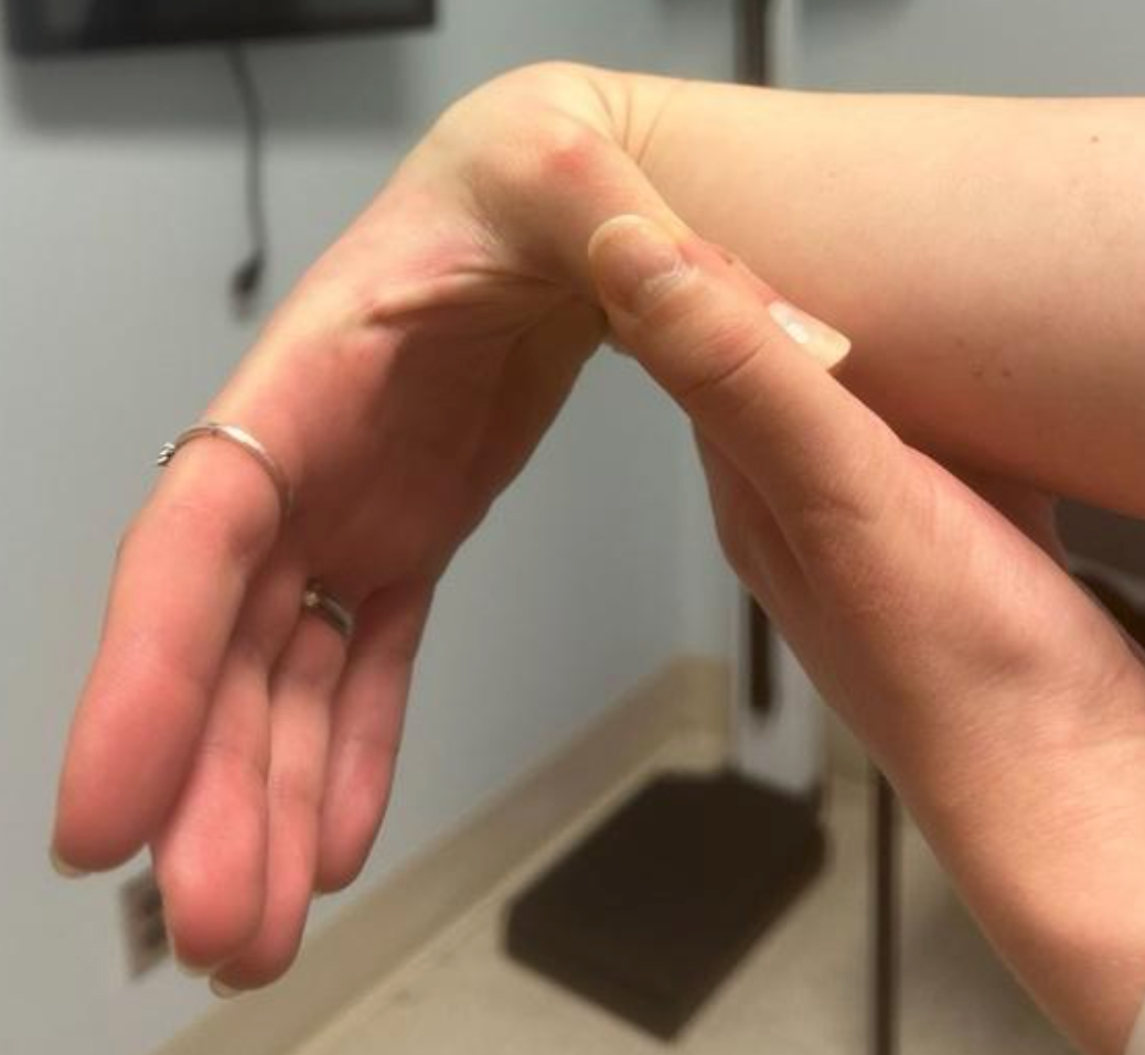 Figure 1. Patient with Ehlers-Danlos syndrome demonstrating joint hypermobility. 