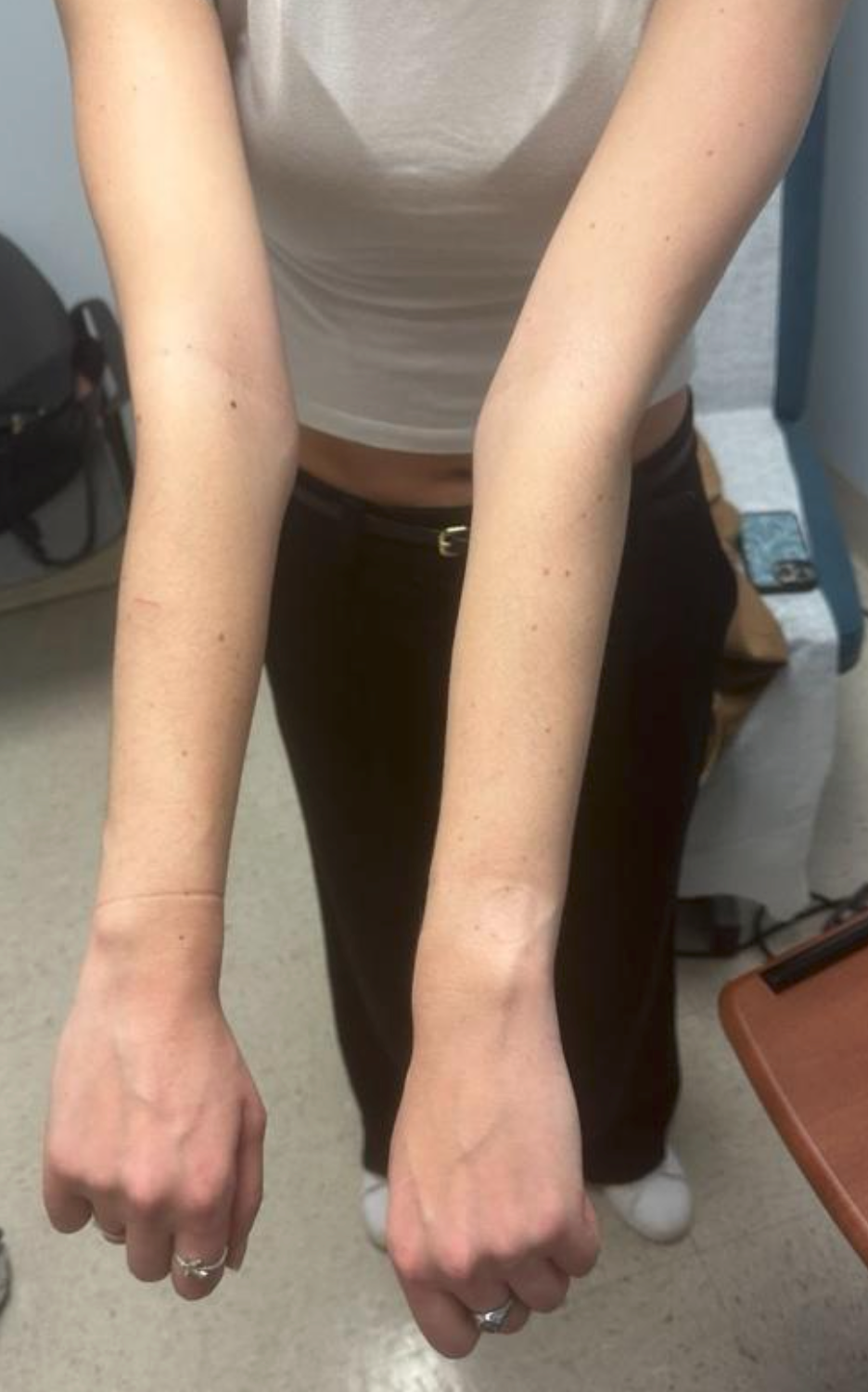 Figure 1. Patient with Ehlers-Danlos syndrome demonstrating joint hypermobility. 