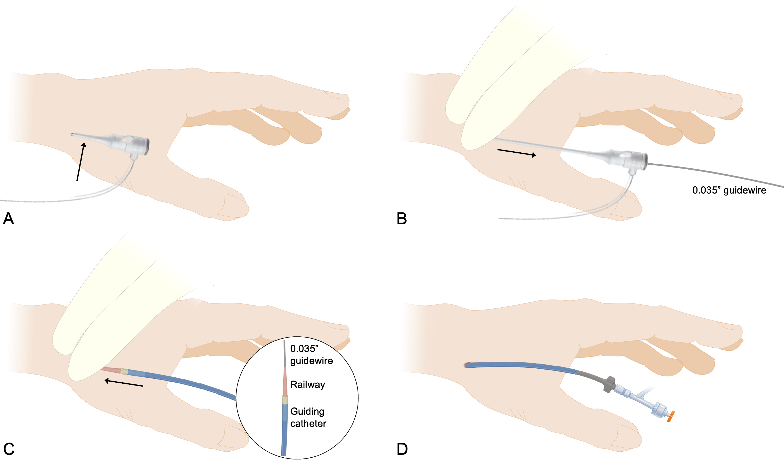 Figure 2.  Illustration of the Distal RailTracking technique.
