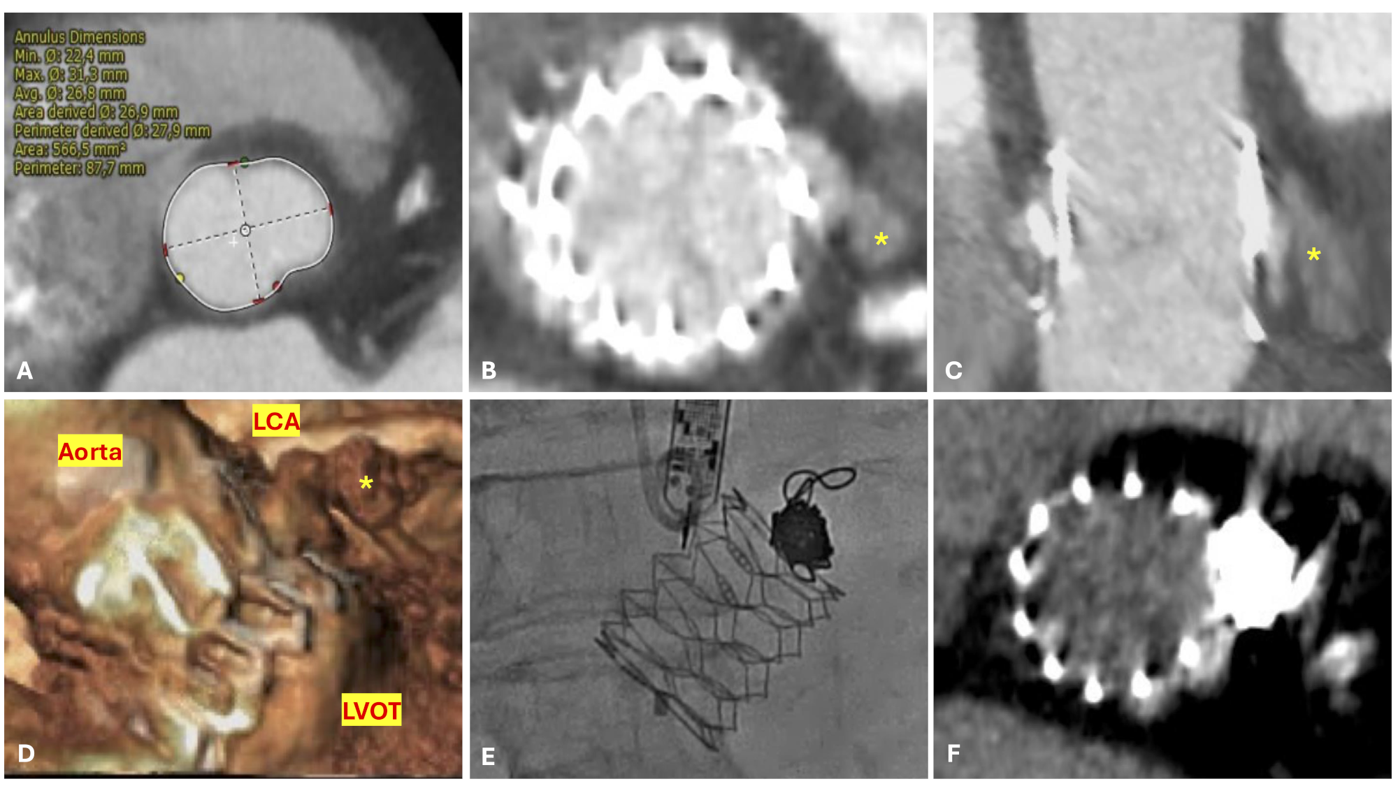 Figure. (A) Native aortic annulus
