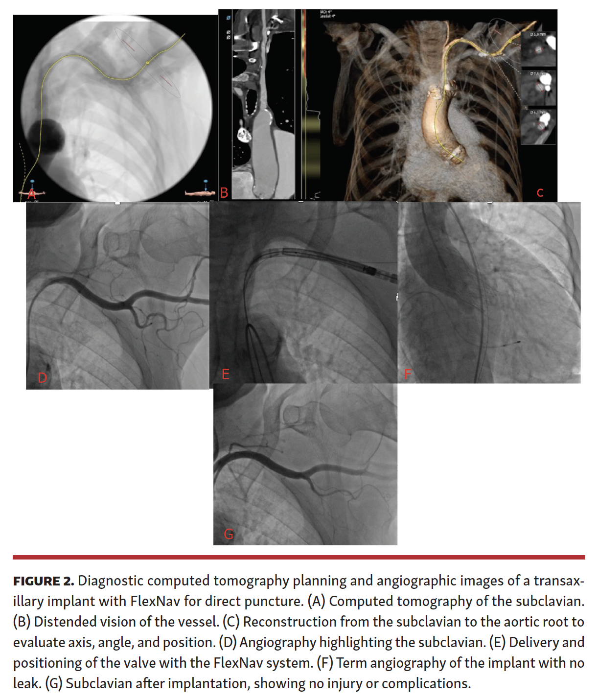 Corcione TAVI Figure 2