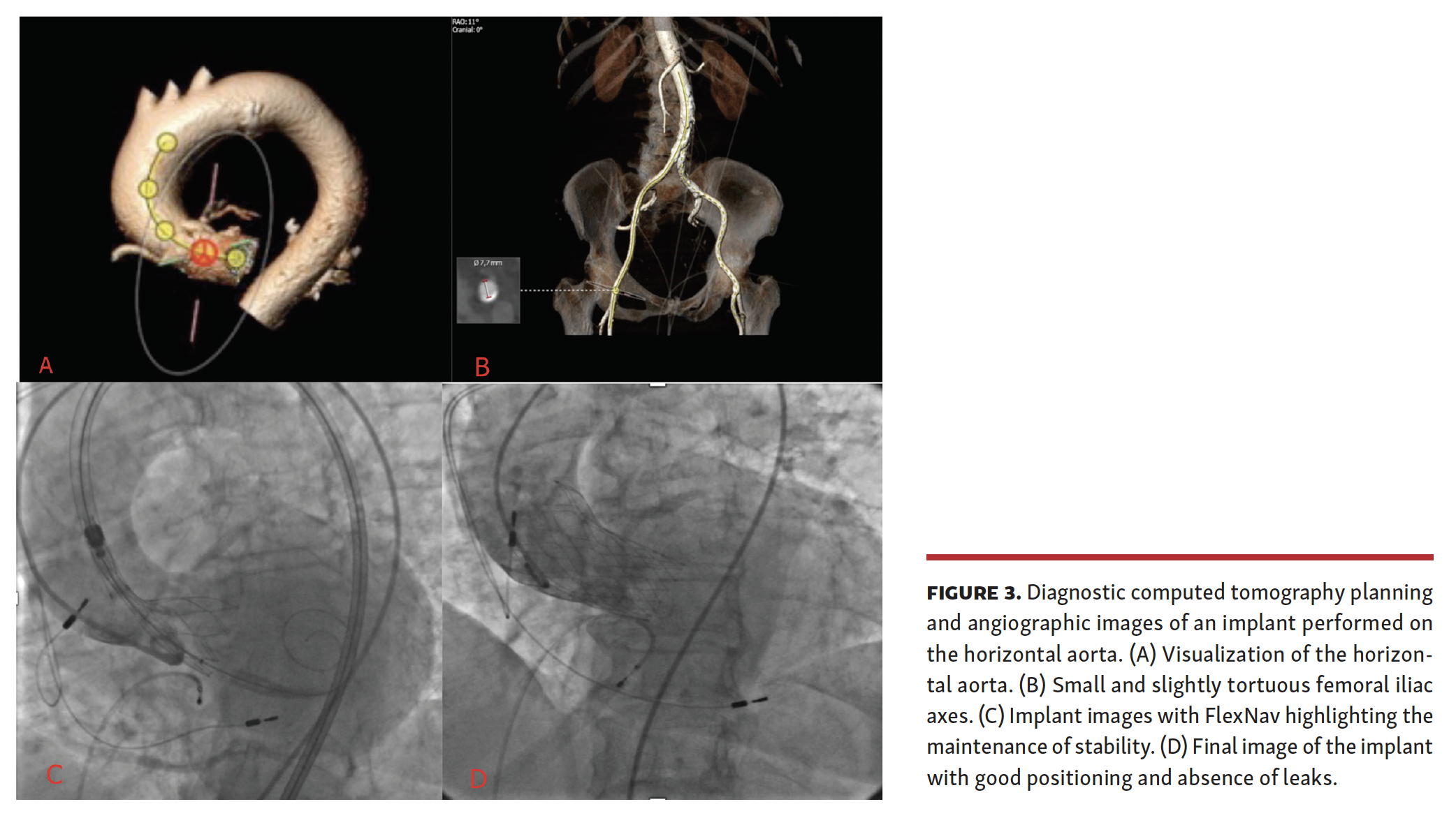 Corcione TAVI Figure 3