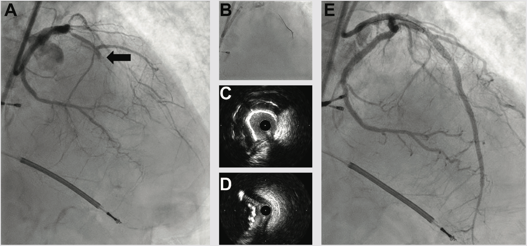 Croce Shockwave Figure 4