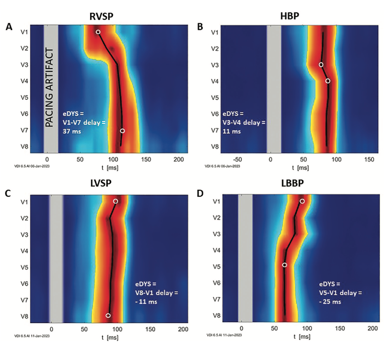 Curila Ventricular Synchrony Figure 2