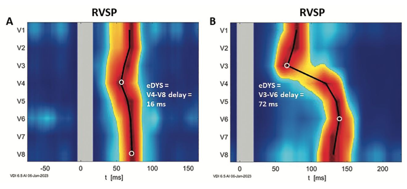 Curila Ventricular Synchrony Figure 3