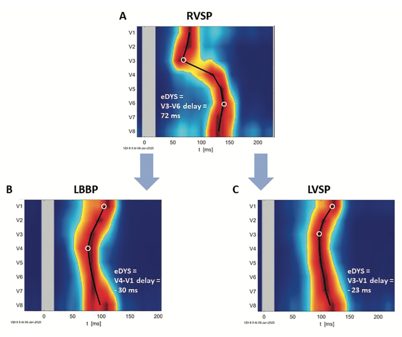 Curila Ventricular Synchrony Figure 4