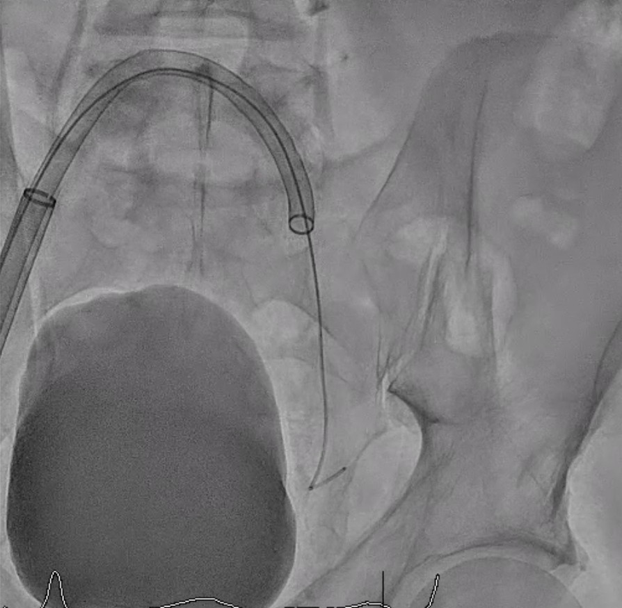 Figure 3. Mother-in-child technique with the FlowTriever system (Inari Medical) in the left common iliac vein.