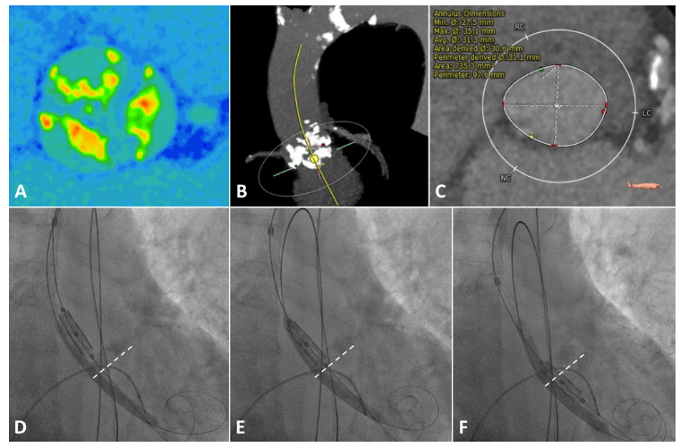 D'Amico Bioprosthesis Figure 1