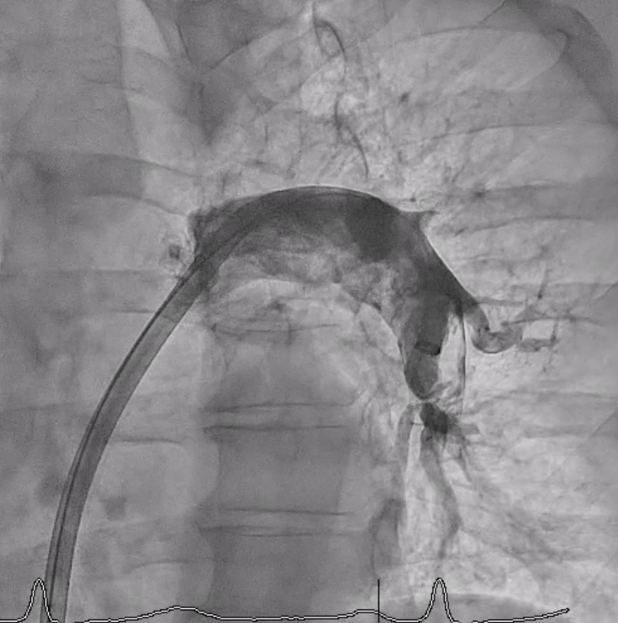 Figure 1. Baseline pulmonary angiography demonstrated a large thrombus in the left pulmonary artery. 
