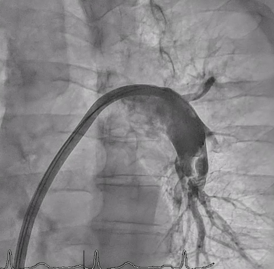 Figure 2. Final pulmonary angiography showed restored flow in the left pulmonary artery after mechanical thrombectomy with the FlowTriever system (Inari Medical).
