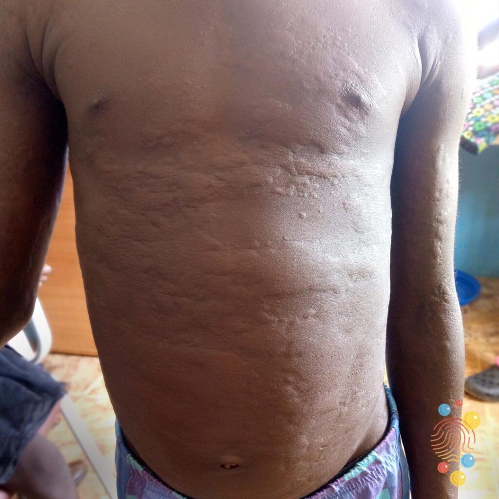 urticaria on dark skin