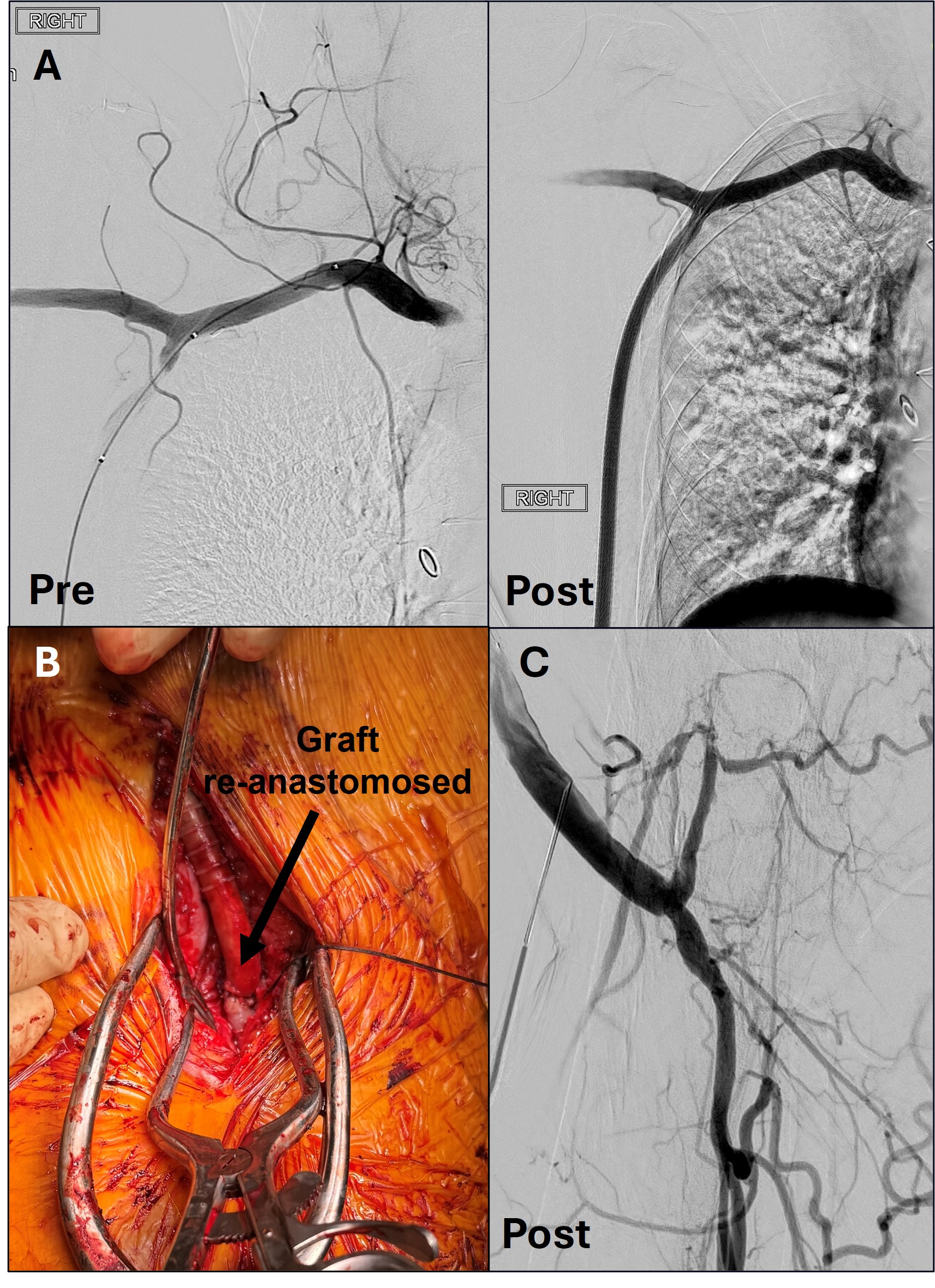 Figure 4. (A) Pre- and post-thrombectomy angiograms of the axillary-profunda bypass graft demonstrating restored flow after thrombectomy with Artix. (B) Intraoperative image of the newly patent graft after it was re-anastomosed. (C) Angiography confirming flow restoration at the distal graft anastomosis and outflow in the profunda.ee additional passes with the Artix device. 
