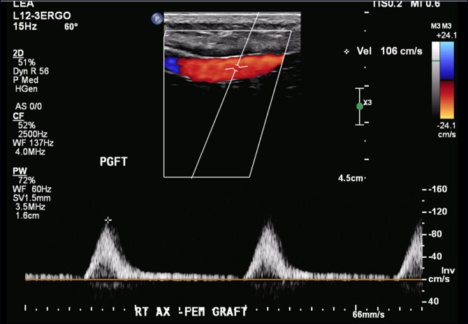 Figure 5. Arterial duplex with color flow imaging and spectral analysis of velocity waveforms of the right lower extremity performed 1 month post procedure showing patent axillary-profunda graft, patent profunda femoral artery, and known chronically occluded superficial femoral artery. 