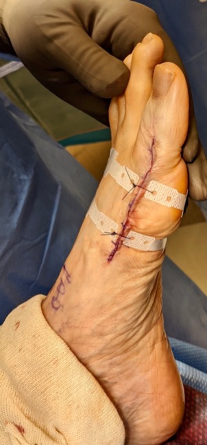 Example of barbed suture closure with ASRD on a first MTPJ arthrodesis.