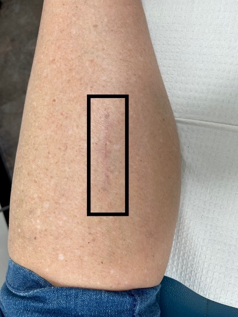 Baumann incision with nearly invisible scar utilizing barbed suture closure with ASRD. 