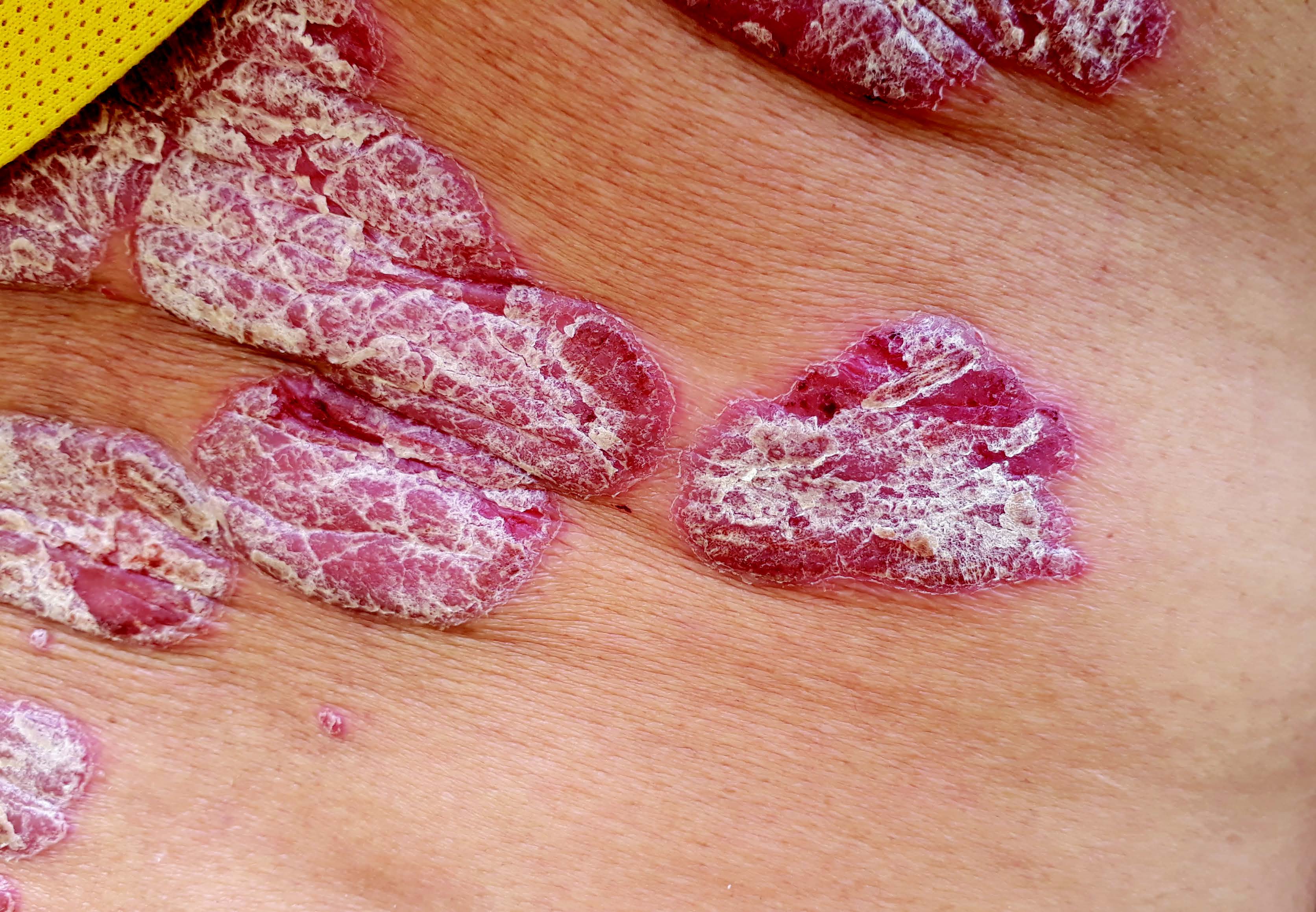 psoriasis