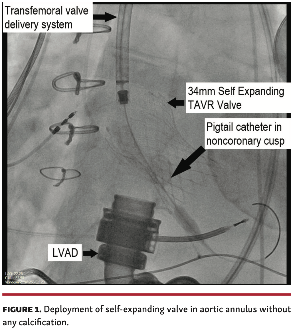Dhillon Aortic Regurgitation Figure 1