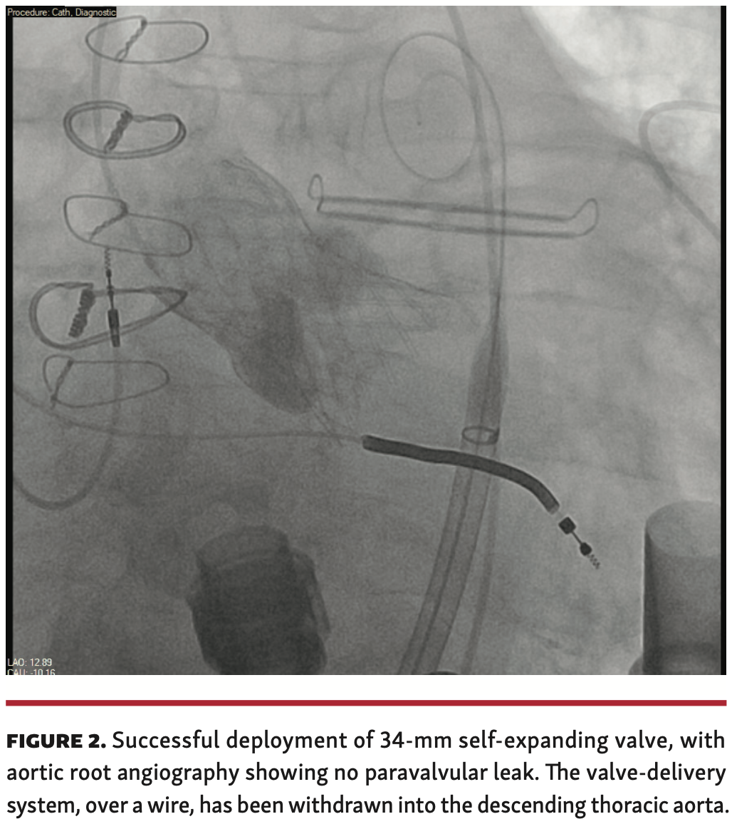 Dhillon Aortic Regurgitation Figure 2