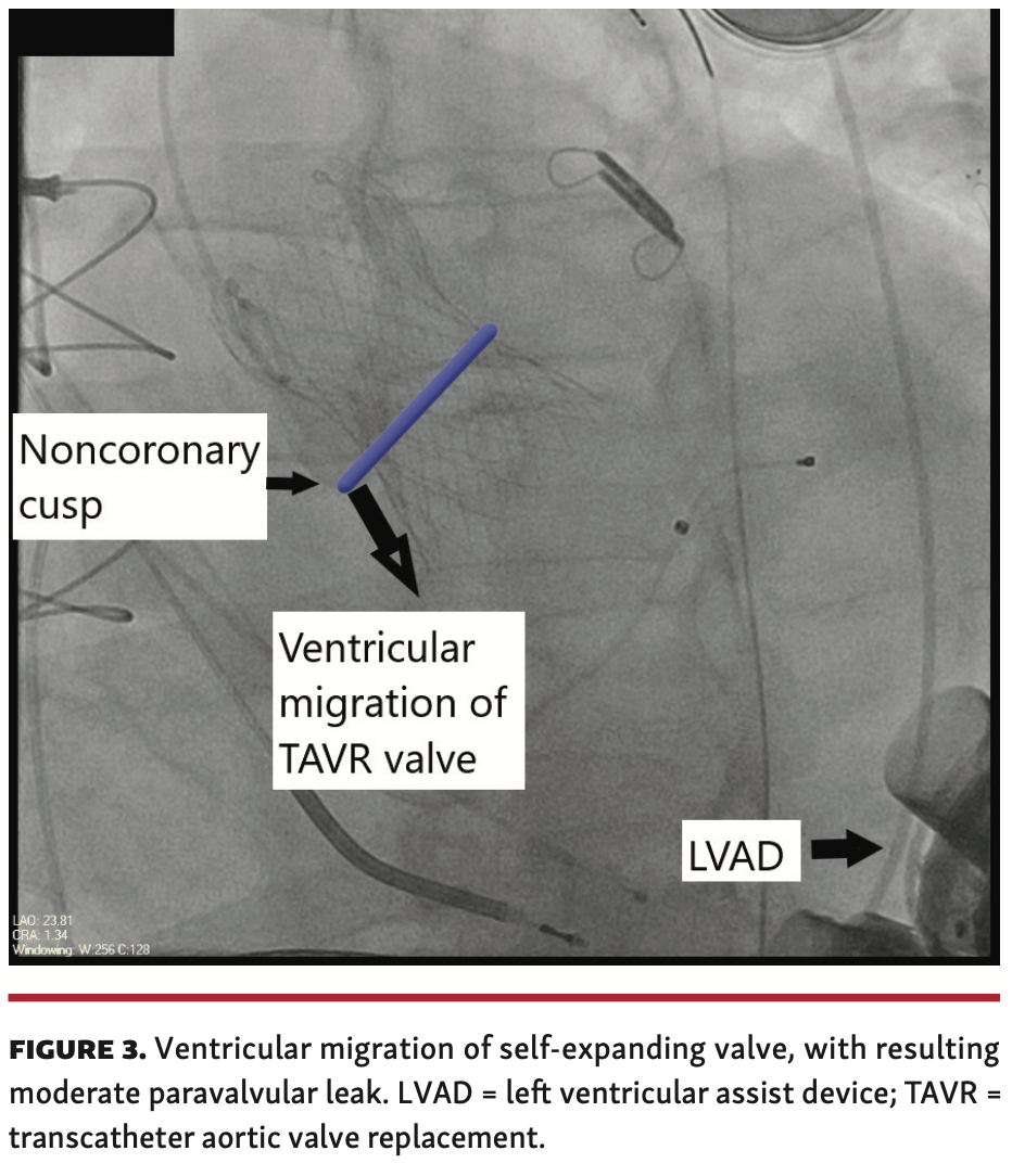 Dhillon Aortic Regurgitation Figure 3