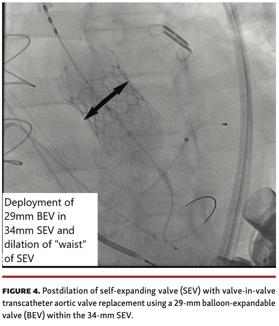 Dhillon Aortic Regurgitation Figure 4