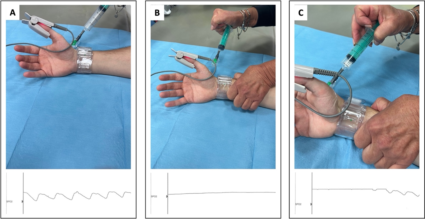 Figure. Modified Reverse Barbeau Test before trans-radial procedure.