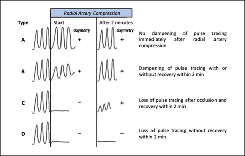Supplemental Figure. Plethysmography profiles