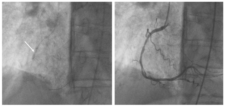 Dimitriadis Lithotripsy Figure 1