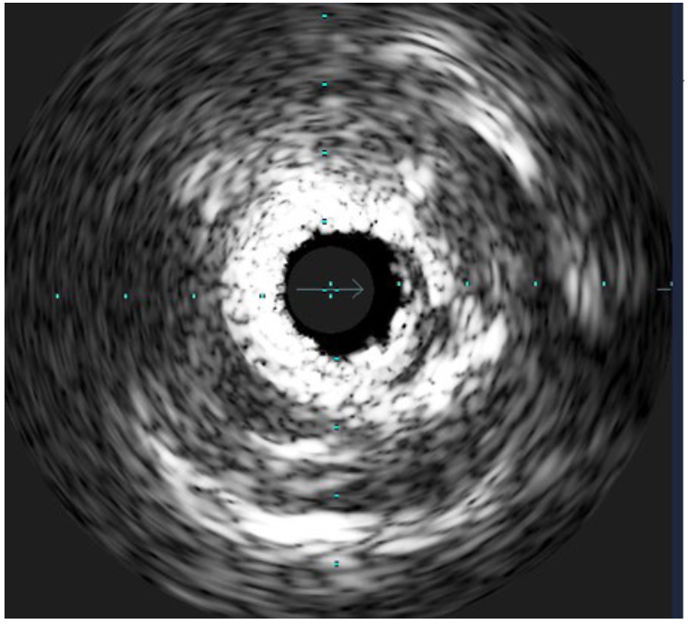 Dimitriadis Lithotripsy Figure 2