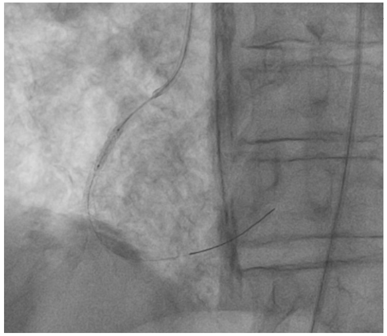 Dimitriadis Lithotripsy Figure 3