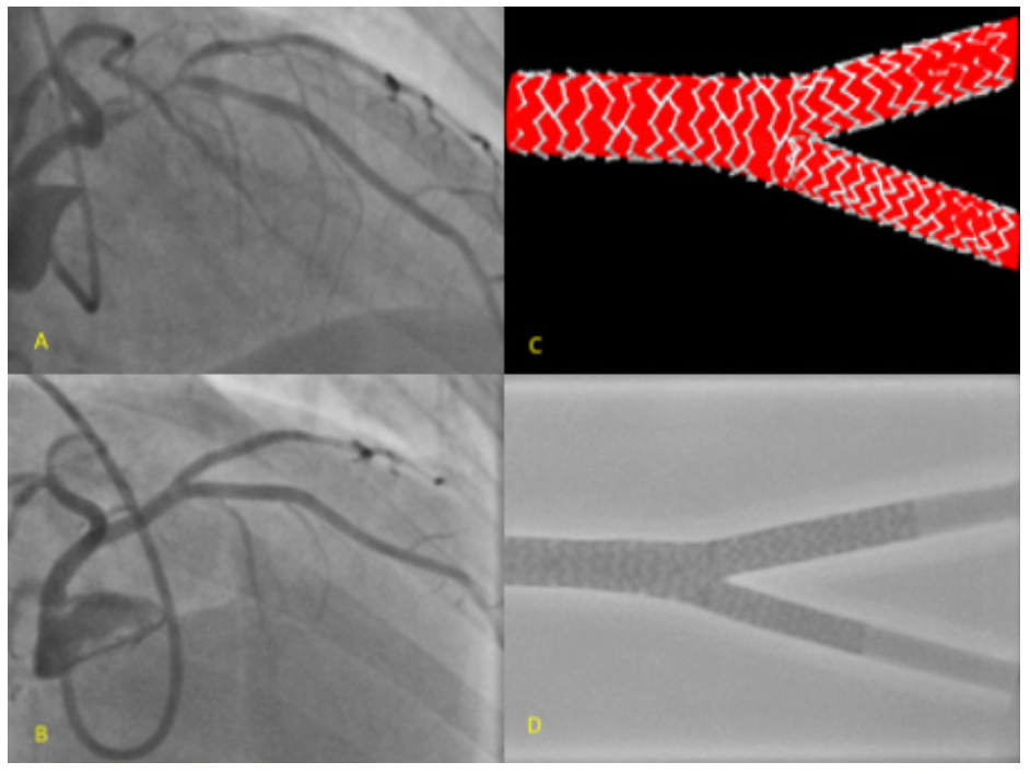 Ding Bifurcation Figure 10