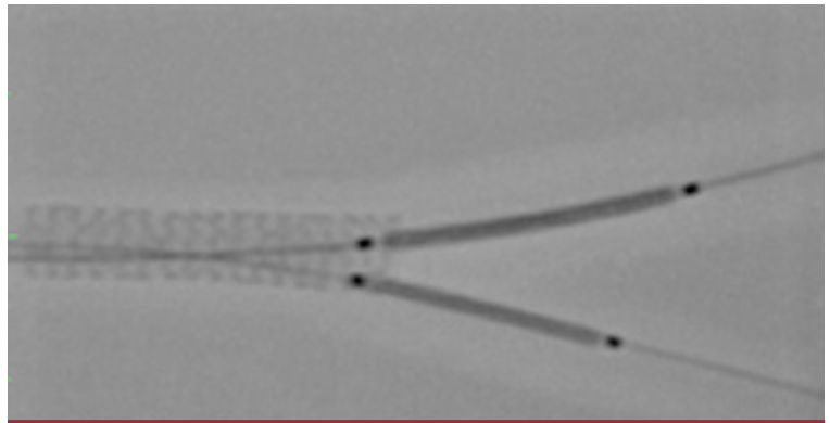 Ding Bifurcation Figure 7