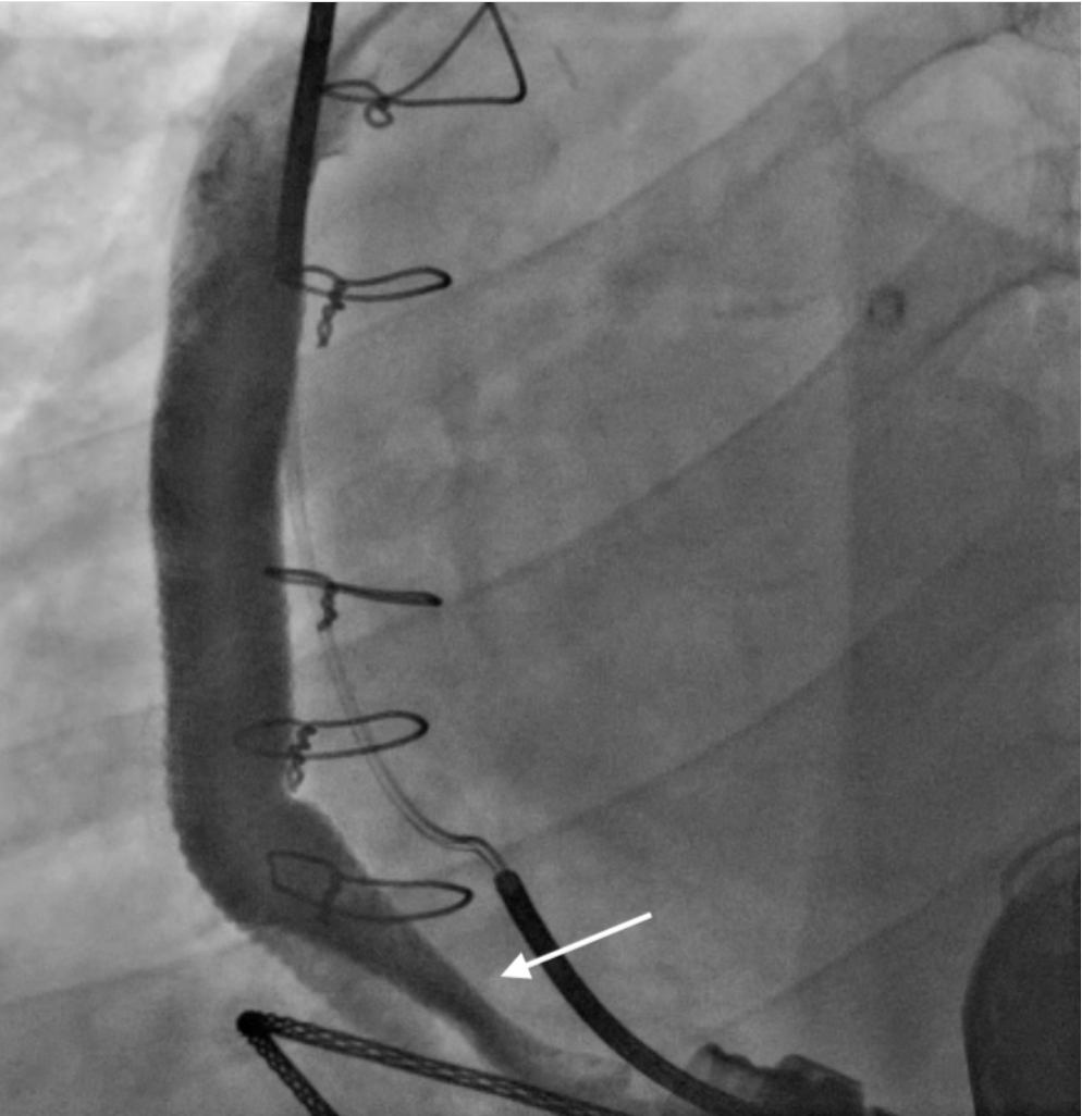 Dogan Angiography Figure 1