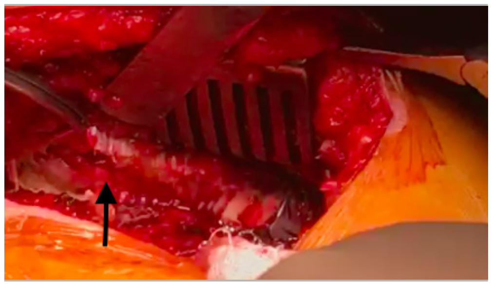 Dogan Angiography Figure 2