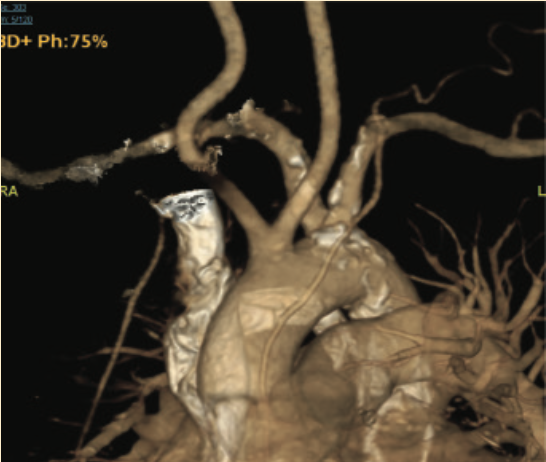Don ACIST CVi System Figure 2