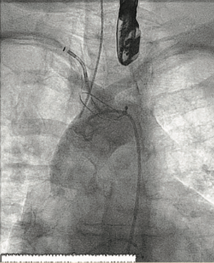Don ACIST CVi System Figure 3
