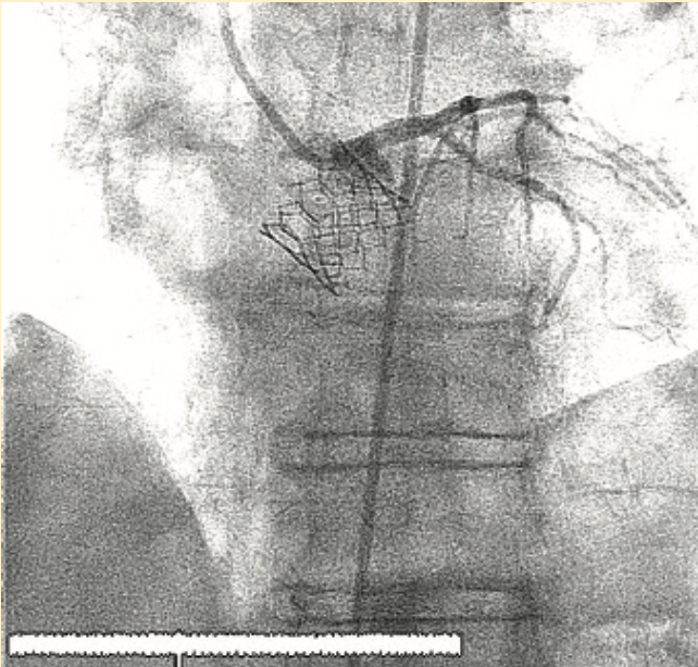 Don ACIST CVi System Figure 5