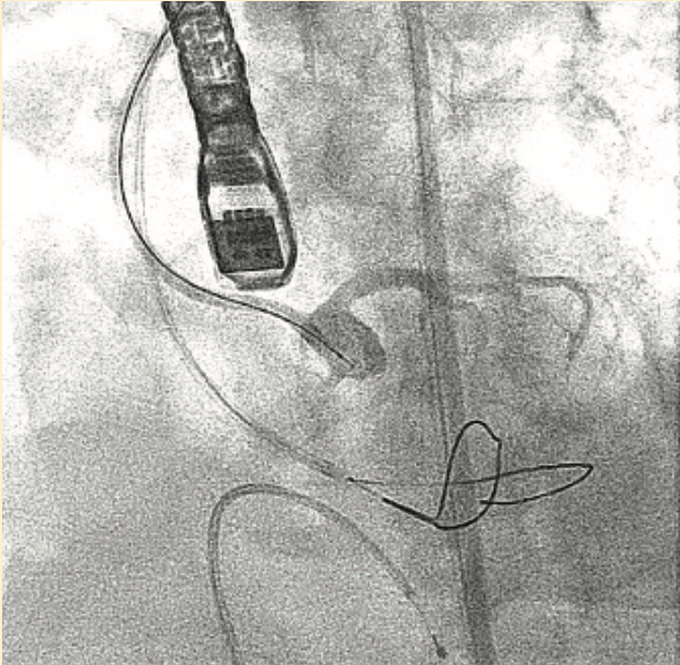Don ACIST CVi System Figure 6