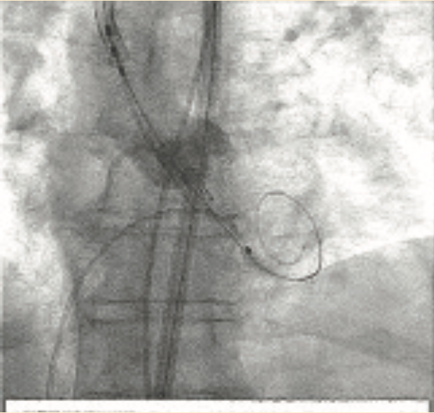 Don ACIST CVi System Figure 7