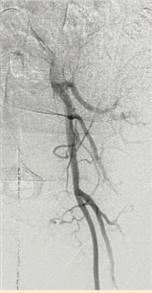 Don ACIST CVi System Figure 8