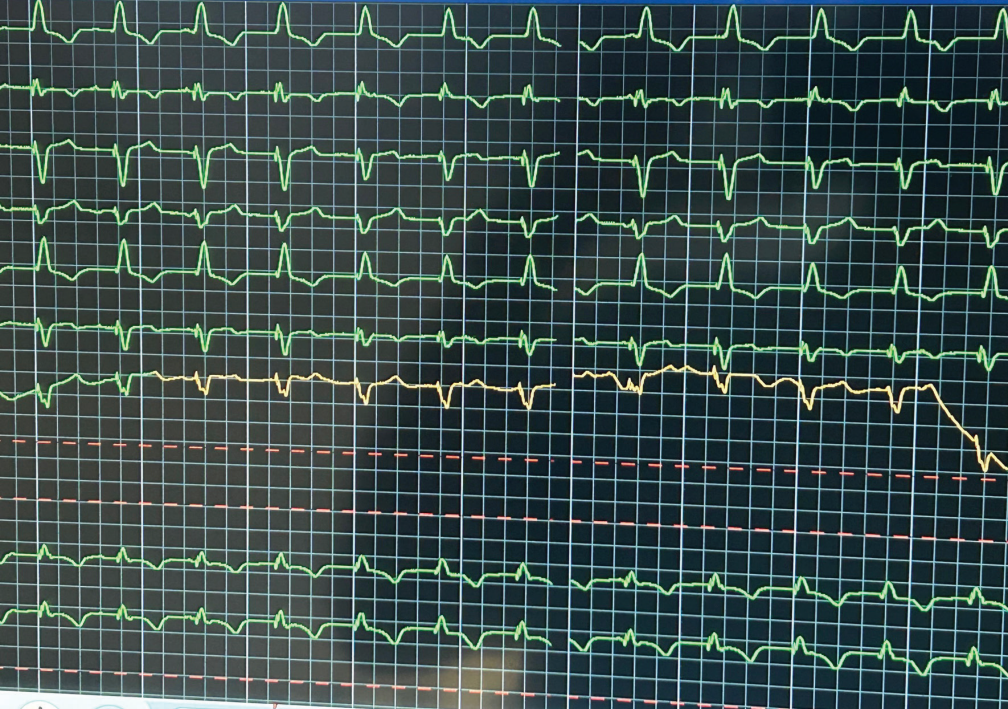 Figure 9. ECG using a sterile V1 electrode. 
