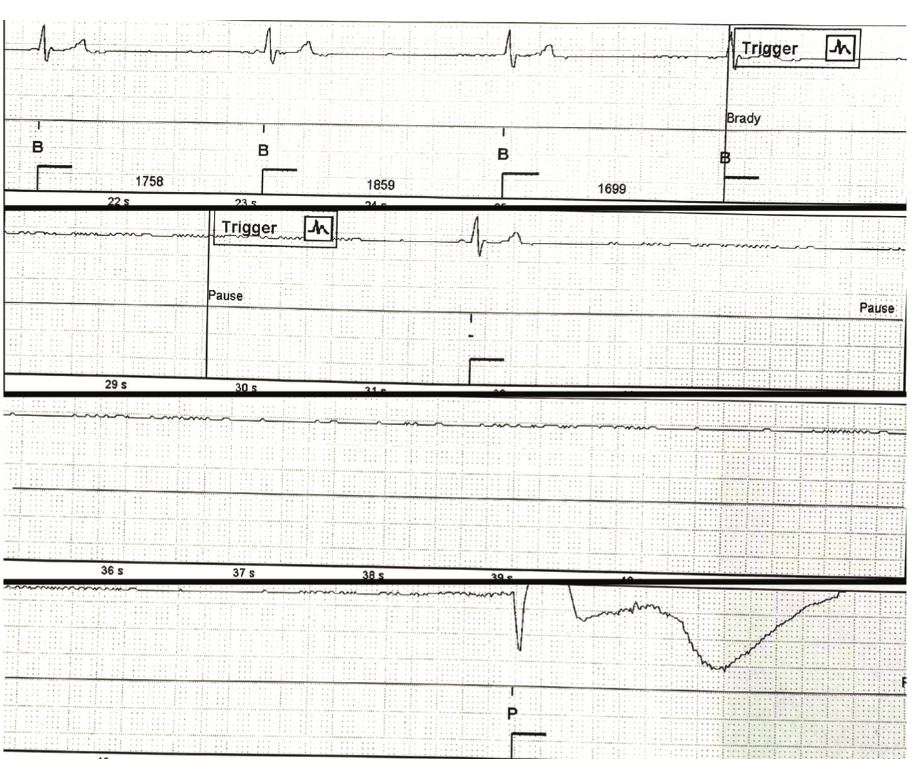 Doshi Pacemaker Figure 1