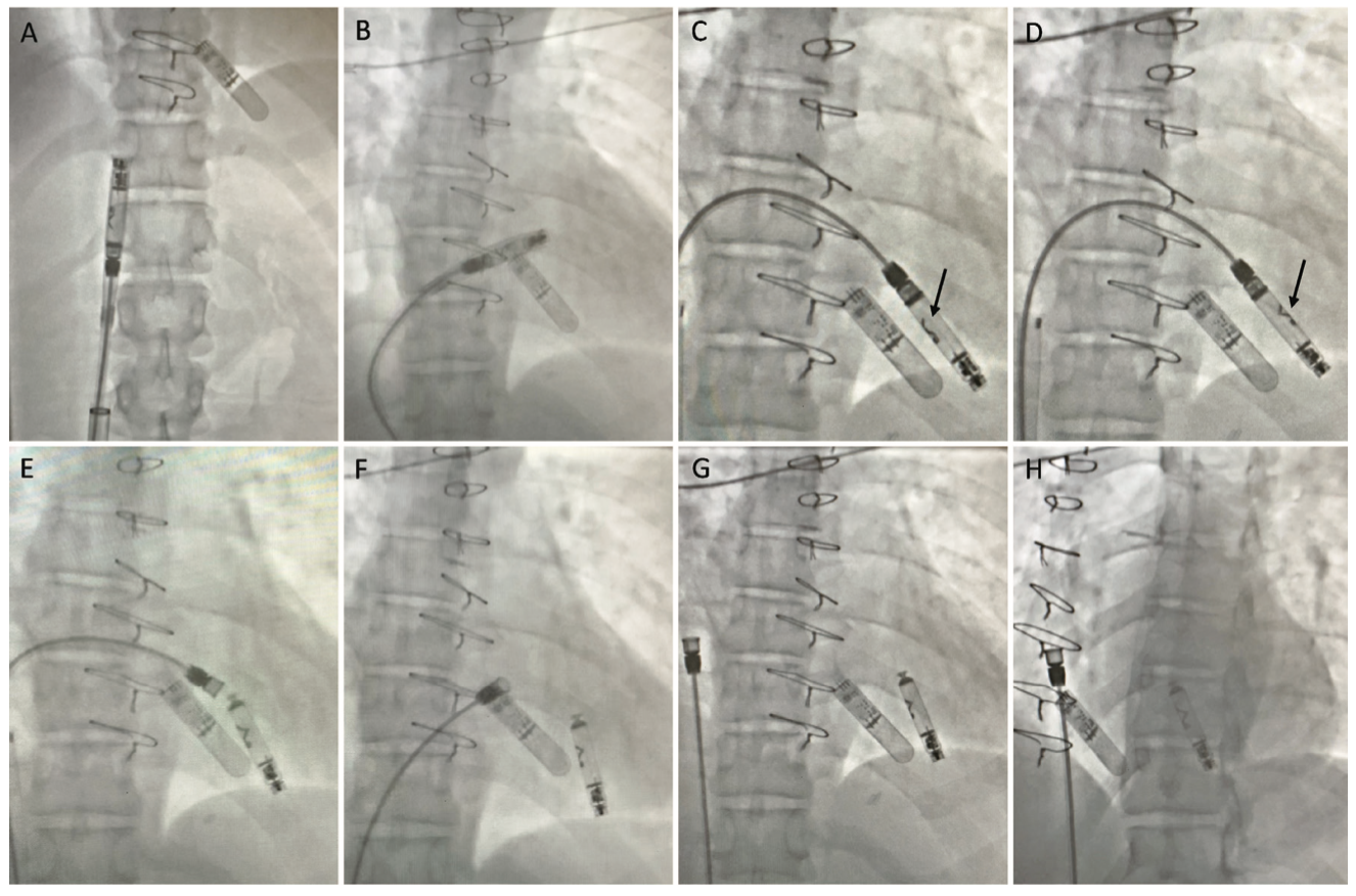 Doshi Pacemaker Figure 3