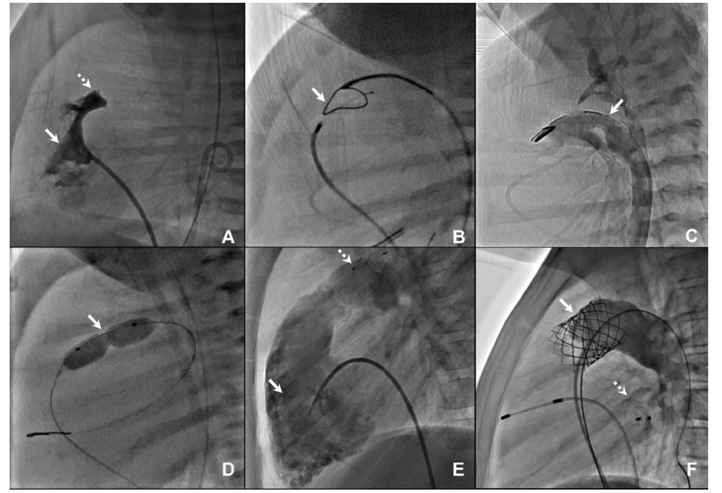Dreger Transcatheter Figure 2