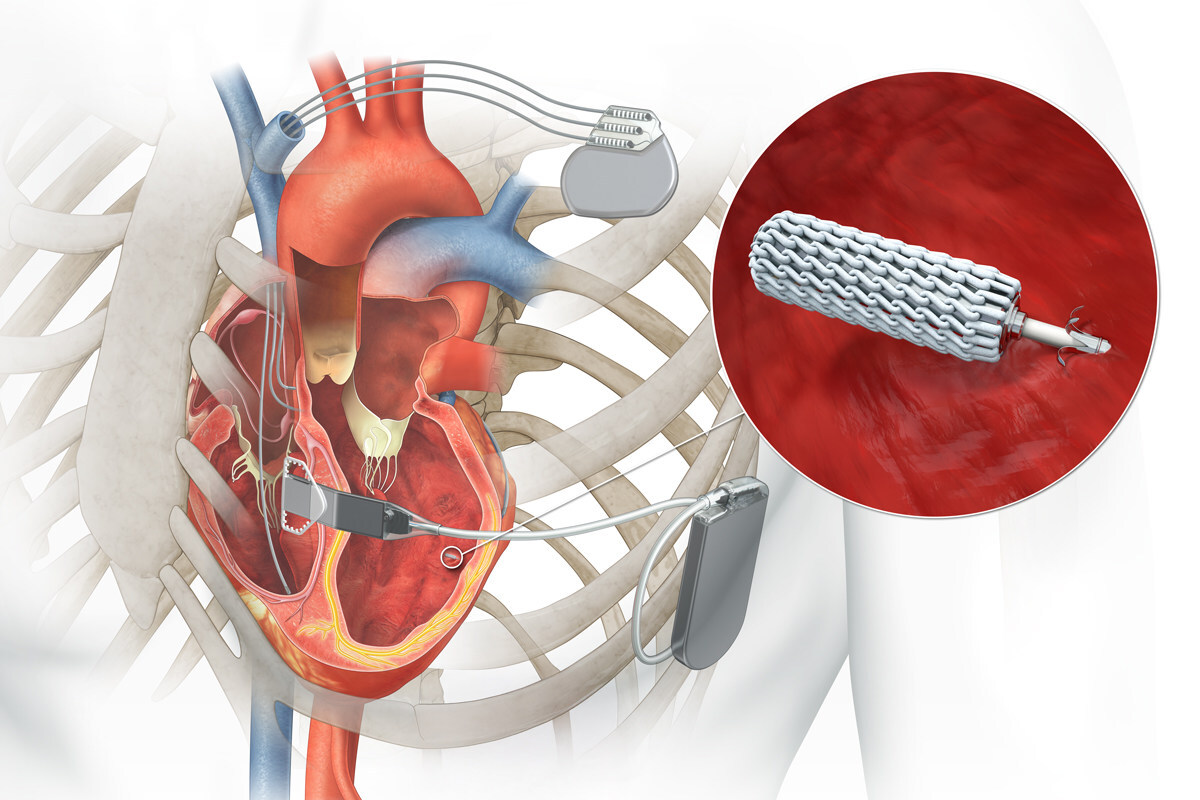 Illustration of implanted WiSE System