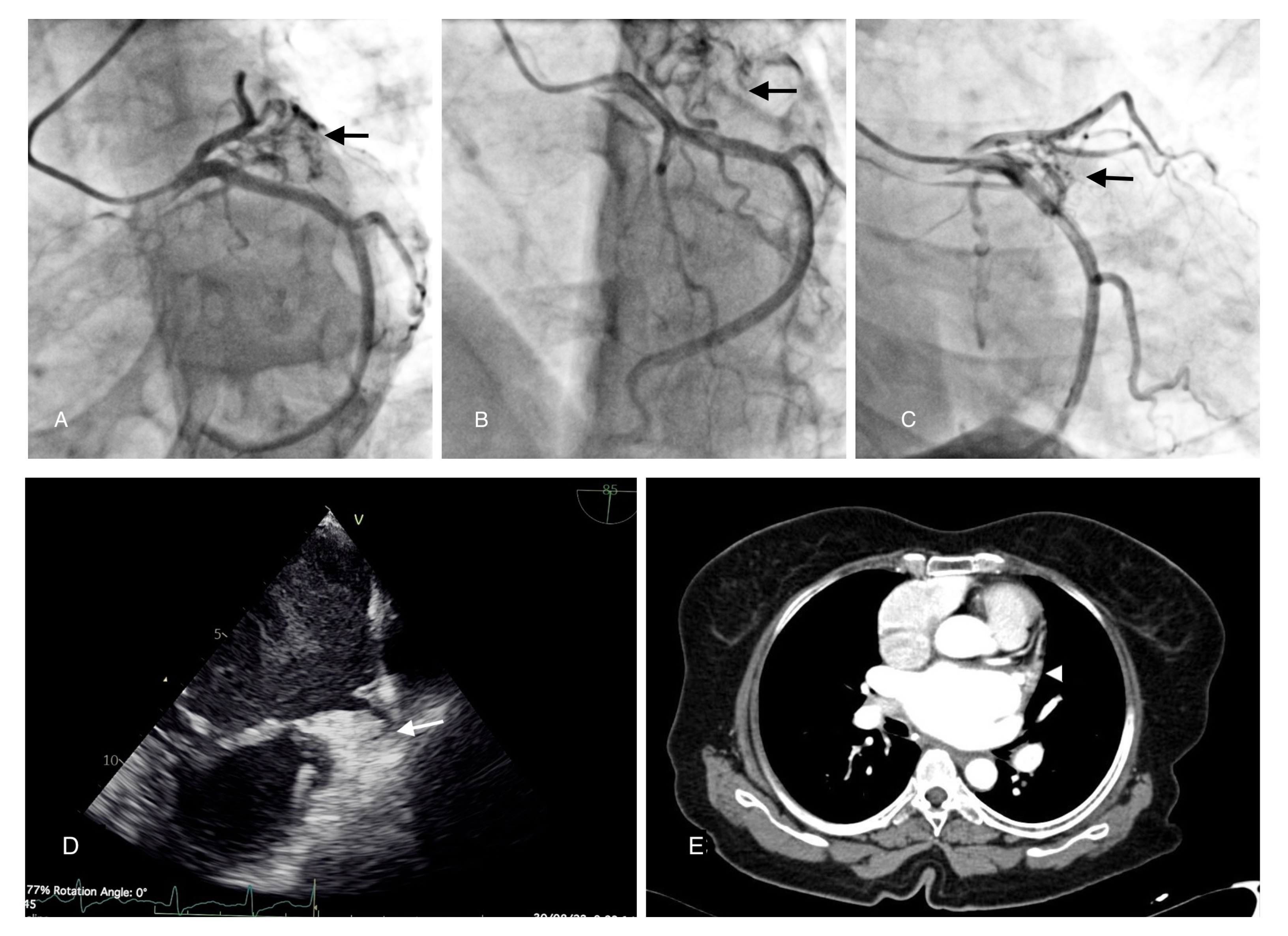 Figure. Coronary angiogram