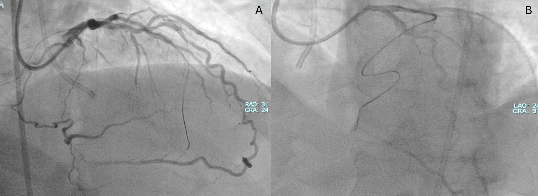 Figure 2.unsuccesful_septal_wiring