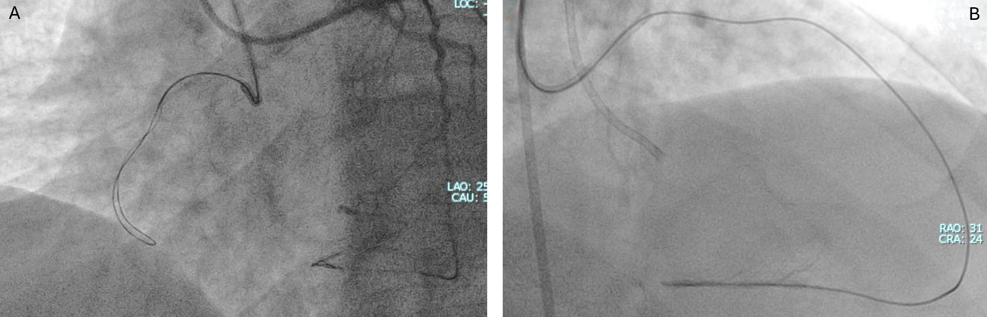 Figure 3. (A) The antegrade knuckled Fielder XT guidewire