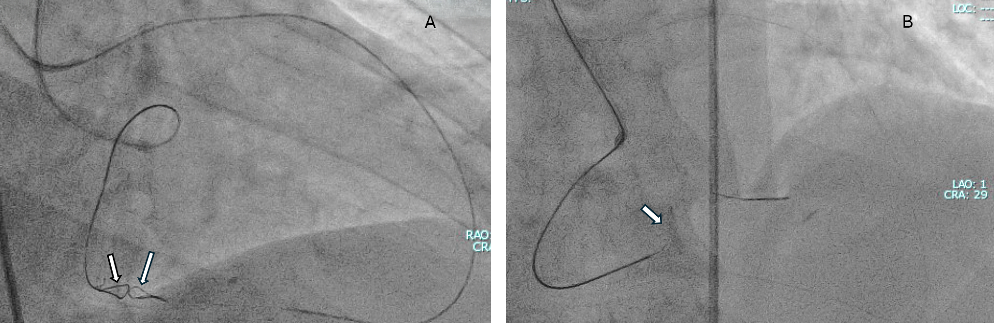 Figure 4. Controlled Antegrade and Retrograde Tracking (CART) technique