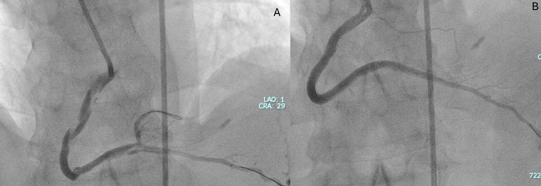 Figure 5. An antegrade wire was delivered into the distal true lumen