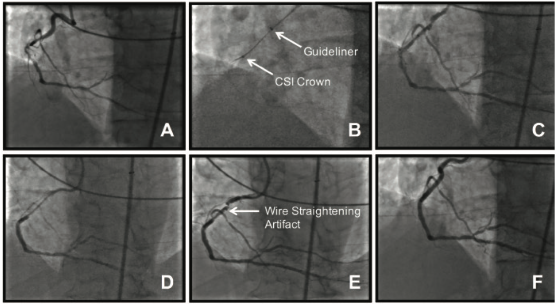 El Hajj Orbital Atherectomy Figure 1